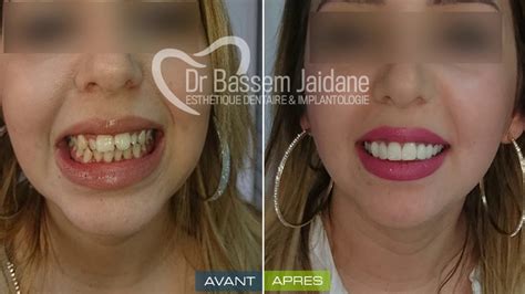 Facettes Dentaires Veneers En Tunisie YouTube