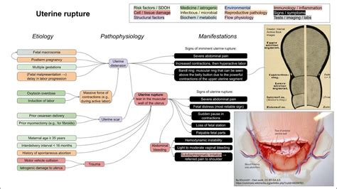 Uterine rupture (mechanism of disease) - YouTube