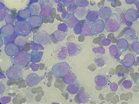 Acute Myeloid Leukaemia Introduction Teachmepaediatrics