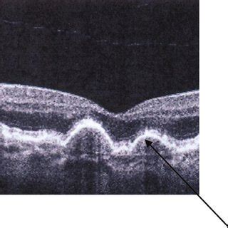 OCT showing normal macular scan. | Download Scientific Diagram