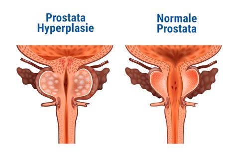 Symptome Und Behandlung Der Gutartigen Prostatahyperplasie Mit