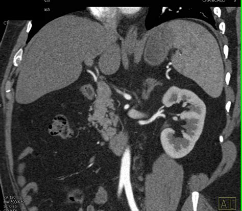 Focal Fatty Infiltration In The Tail Of The Pancreas Pancreas Case