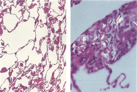 Emphysema Intechopen