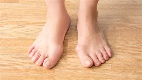 7 Signs It S Time To Consider Bunion Surgery Podiatrist Foot Ankle