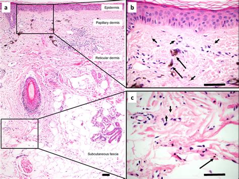 Tattoo pigment in interstitial spaces of the dermis and subcutaneous ...