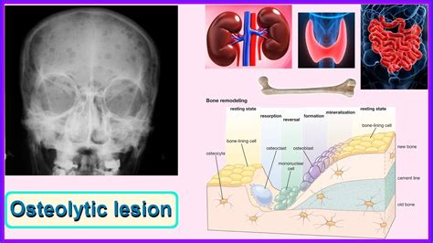 Osteolytic Lesion YouTube