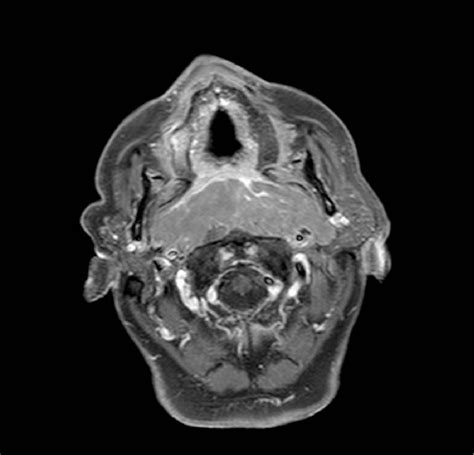 Figure 3 From Imaging Of Lymphomas Of The Head And Neck Semantic Scholar