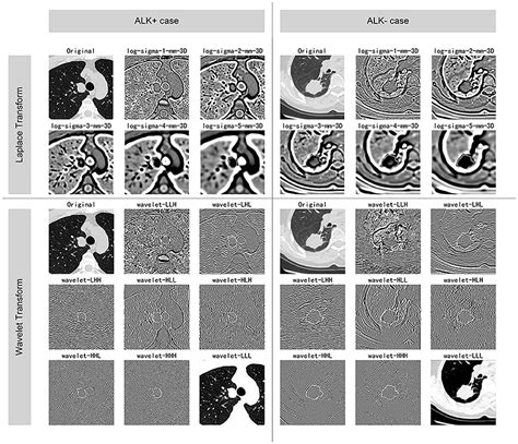 Frontiers Clinical Conventional Ct And Radiomic Feature Based Machine Learning Models For