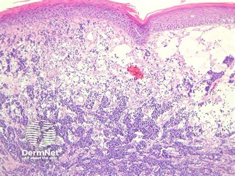 Merkel cell carcinoma pathology