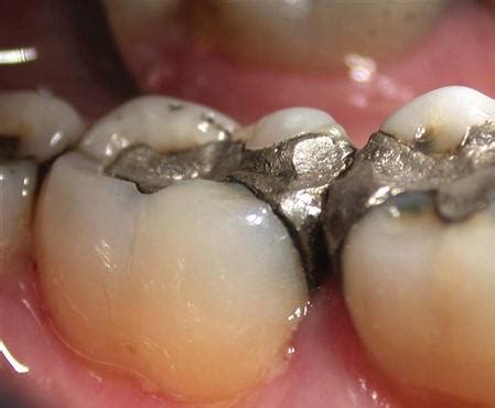 9. Dental Amalgam | Pocket Dentistry