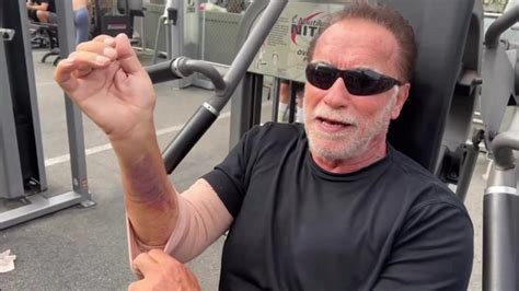 Arnold Schwarzenegger works out with badly bruised arm while recovering ...