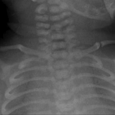 Chest x-ray showing left-sided clavicular fracture. Case courtesy of ...