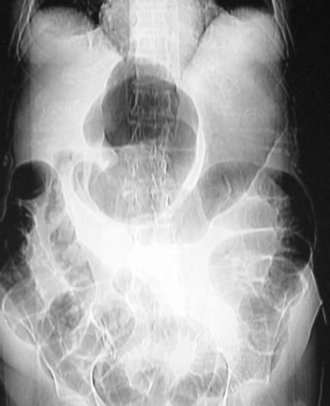 Plain Abd O M I N A L X R A Y Showing A Gasfilled Epigastric Mass