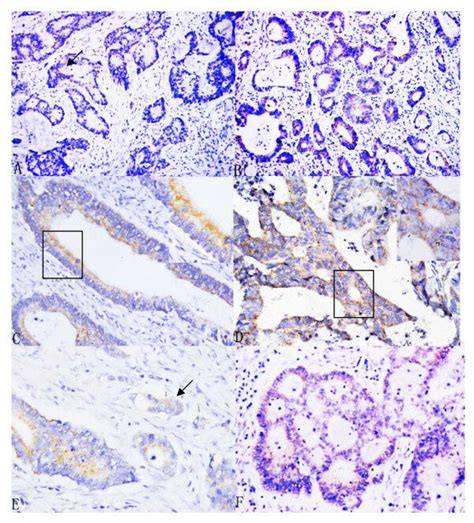 The Expression Of Cd133 In Colon Cancer Patients With Stage Iiib 10 ×