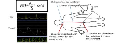 Measurement Of Carotid And Femoral Pulse Wave Velocity Using Arterial