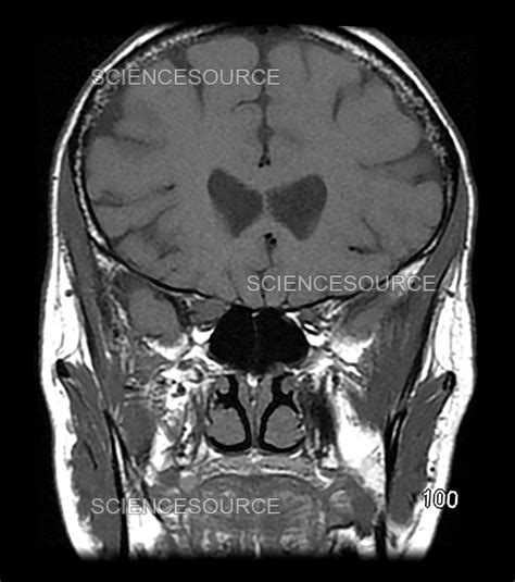 Photograph | MRI Optic Nerve Glioma in Adult | Science Source Images