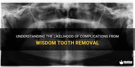 Understanding The Likelihood Of Complications From Wisdom Tooth Removal