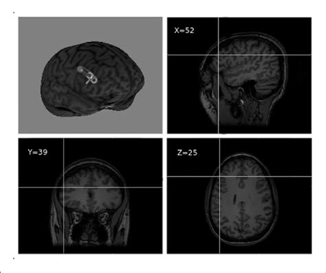 | Right dorsolateral prefrontal cortex (DLPFC) TMS target visualized... | Download Scientific ...