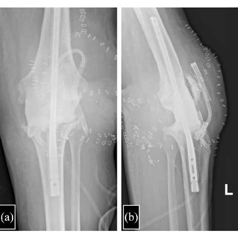 Anteroposterior A And Lateral B Radiographs Of The Knee In Which An