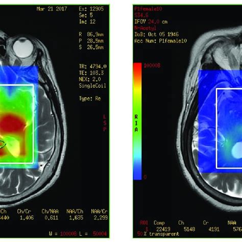 Magnetic Resonance Spectroscopy With Three Dimensional Chemical Shift