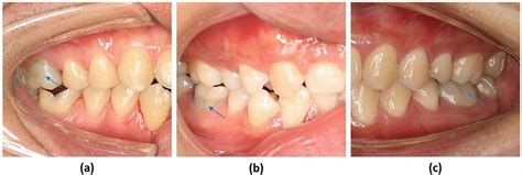 Tooth Discoloration Was Observed At The 12 Month Follow Up On The Teeth Download Scientific