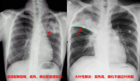 胸片浸润型肺结核的诊断