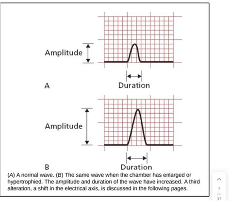 Ekg Hypertrophy And Enlargement Of The Heart Flashcards Quizlet