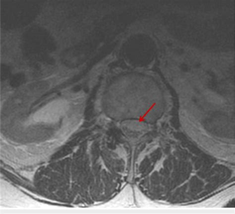 Mri Scan T2 Weighted Axial View Of The Lumbar Spine Demonstrates