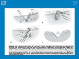 Eyelid laceration repair with defects.pptx