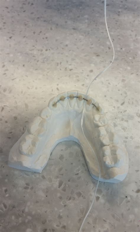 How To Floss With A Permanent Retainer