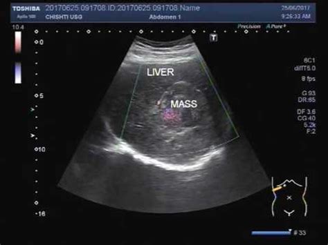 Liver Masses Ultrasound