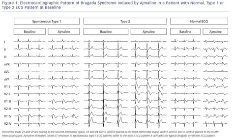 Electrocardiographic Pattern Of Brugada Syndrome Radcliffe Cardiology