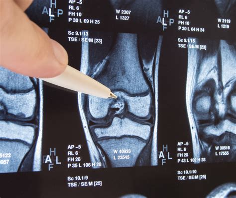 What To Do About Bone-On-Bone Knee Pain