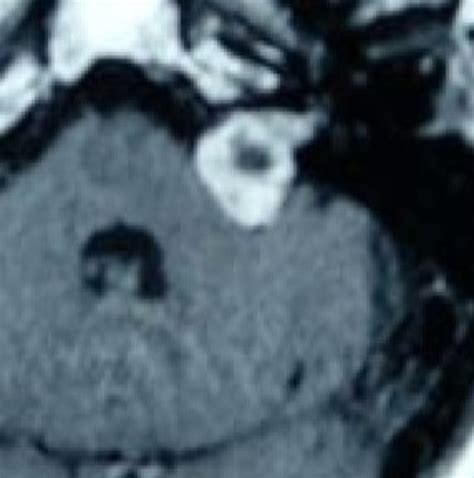 Clinical Pathology Glossary Neurofibromatosis Type 2 Ditki Medical