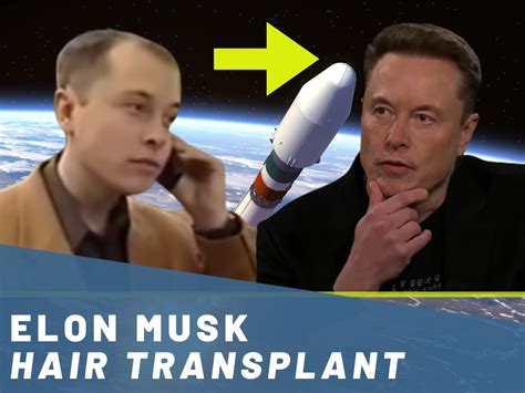 Elon Musk Hair Transplant Hair Loss Analysis With Photos