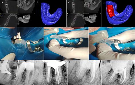 A Cbct Scan Showing Furcation Perforation B Stl File Of Cast Scan Of