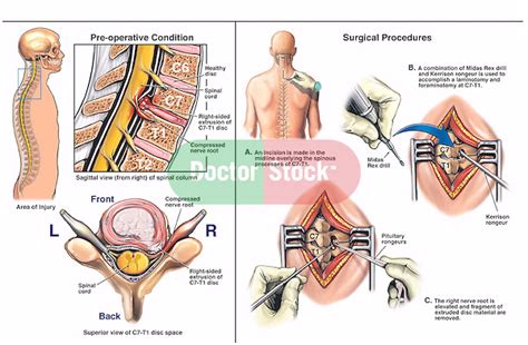 C7-T1 Extrusion with Laminotomy, Foraminotomy and Discectomy Procedures ...