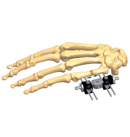 Hand Bone Non Union Treatments Orthofix Abs