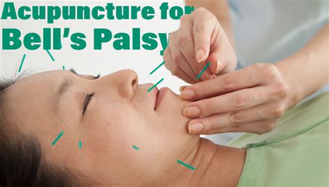 Acupuncture For Bells Palsy Chiro Acupuncture Elgin