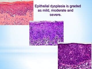 Epithelial Dysplasia Ppt