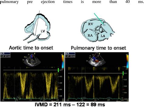 Figure 1 From Echocardiographic Assessment Of Inter And Intra Ventricular Dyssynchrony In Heart