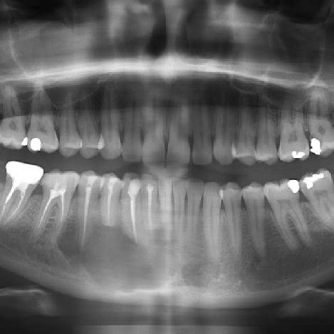 Orthopantomograph Showing A Unilocular Radiolucent Lesion In The Ramus