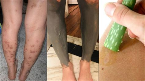 Bentonite Clay Aloe Vera Treatment Get Rid Of Dark Marks Scars On