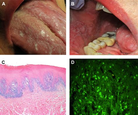 The Diagnostic Challenges Of Separating Chronic Ulcerative Stomatitis