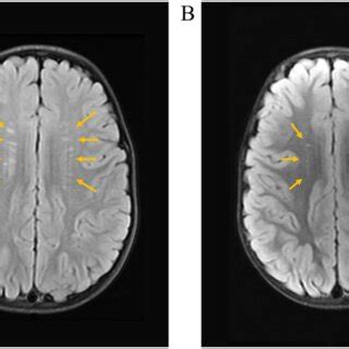 Brain MRI pre-and post treatment. A. Brain MRI prior to treatment ...