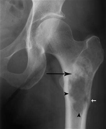 Chondrosarcoma Pathology Orthobullets