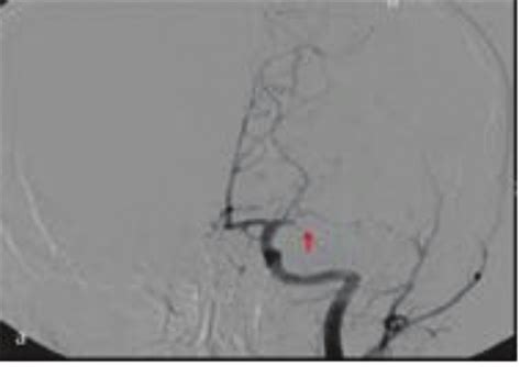 Anteroposterior Ap View Of Cerebral Angiogram In An Acute Ischemic