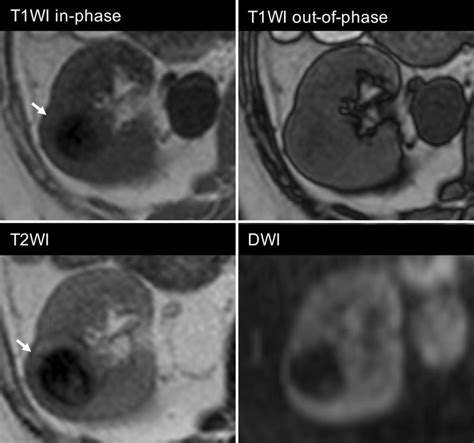 On Mri The Mass Shows Hypointensity On Both T1wi And T2wi The Signal