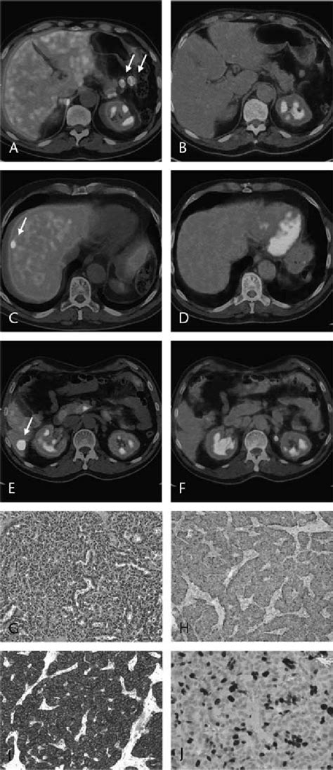 Fused 68 Ga DOTATOC PET CT Showing Increased Tracer Uptake In 2