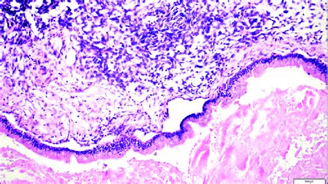 Cyst Epithelium With Mucinous Epithelium And Mucinous Secretion And Sex